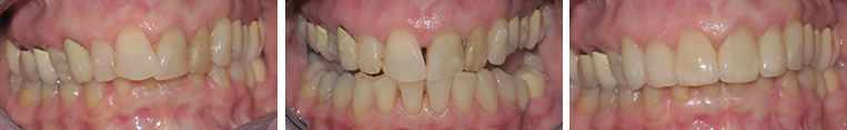orthodontics invisalign and veneers