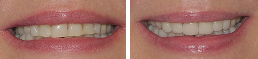 Restorations and Veneers