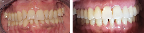 porcelain veneers